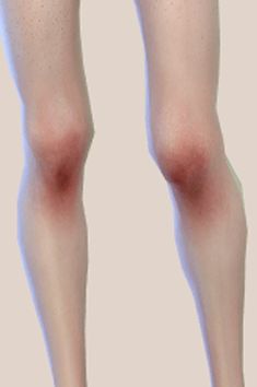 the legs and ankles of a woman with varicous on her leg, showing red spots