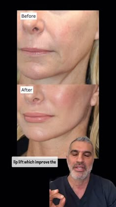 How to Get NATURAL Facelift Results! Mid Face Lift, Thread Lift Face, Face Procedures, Natural Facelift, Facelift Before And After, Lip Lift, Face Lift Surgery, Natural Face Lift, Cheek Fillers