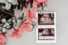 an x - ray image is shown next to pink flowers on the wall and in front of it