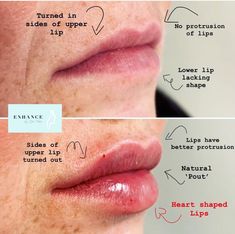 M Shaped Lips With Filler, Natural Lip Fillers Small Lips, Small Lips Aesthetic, Lip Fillers Juvederm, Full Lips Makeup, Face Makeover, Lip Surgery, Heart Shaped Lips, Facial Procedure