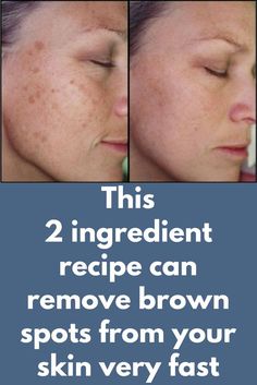 This 2 ingredient recipe can remove brown spots from your skin very fast Brown spots on the skin are also known as liver spots, major causes behind these spots include excessive exposure to sun rays. The best pat is that it is not very difficult to get rid of them if you take action quickly and cure is also natural so there is no side effect. For this … Dark Patches On Skin, Face Remedies, Face Treatments, 2 Ingredient Recipes, Wrinkle Remedies, Skin Hyperpigmentation