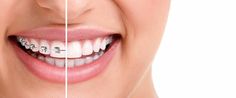 Invisalign Discounts Teeth Braces, Metal Braces, Natural Teeth Whitening, Dental Problems, Dental Services