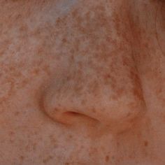 a close up of a person's face with frecks on her skin