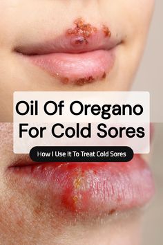 Save this pin to learn how I use oil of oregano for cold sores. If you’re looking for a natural cold sore remedy that packs a punch, this might become one of your favorites, too.