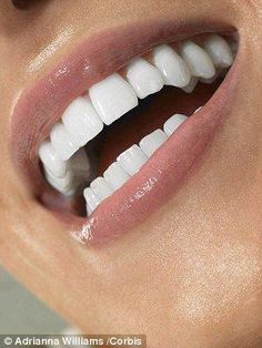 Leah Hardy Leah got porcelain veneers 18 years ago at age 34, costing £4,000. She was never warned her teeth would be drilled to tiny, mis-shapen stumps. Homemade Mouthwash, Pretty Teeth, Veneers Teeth, Beautiful Teeth, Loose Tooth, Perfect Teeth, Teeth Braces, Teeth Implants, Dental Bridge