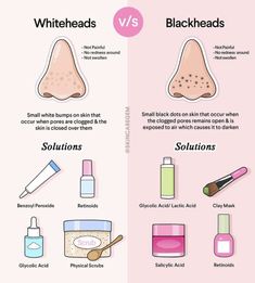 How to prevent black heads and whiteheads what are they what products to use to treat whitehead and black heads Things That Are Good For Your Skin, How To Get Rid Of Black Heads, Perfect Skincare Routine, Black Heads, Good Skin Tips, Skincare Brands