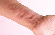 Ulcerative colitis rash can be painful and cause serious skin issues if not treated early. Click here to learn more about its causes, symptoms, and treatments. Rash Causes, White Patches, Chronic Inflammation, Skin Diseases, Skin Issues, The Doctor