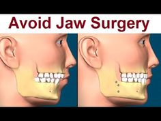 Fix Overbite, Chin Surgery, Corrective Jaw Surgery, Surgeon Quotes, Wisdom Teeth Funny, Orthognathic Surgery, Maxillofacial Surgery, Sensitive Teeth Remedy, Oral Maxillofacial