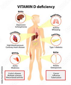 Download Vitamin D deficiency. symptoms and diseases Stock Vector and explore similar vectors at Adobe Stock. Skin Bumps, Vitamin D Supplement, Vitamin D Deficiency, Vitamin Supplements, The Human Body, Autoimmune Disease, Vitamin D, Vitamins And Minerals, Personal Trainer