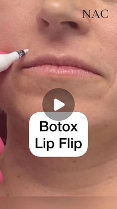 Lip Botox Natural, Lip Botox Before And After, Lip Lift Before And After, Lip Filler On Small Lips, Lip Flip Before And After, 1 Ml Lip Filler Before And After, Lip Flip Fibroblast, Lip Filler Styles, 0.5ml Lip Filler Before And After