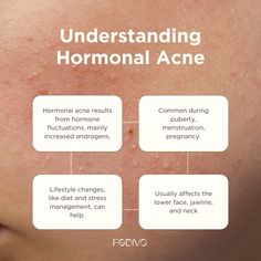 Acne Quotes, Skincare Post Ideas, Hormonal Acne Diet, Mom Community, Skincare Content, Acne Diet, Blind Pimple, Beauty Skin Quotes, Pimples Under The Skin