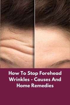 Discover a powerful, quick-acting remedy that can visibly reduce wrinkles in just 24 hours. This simple solution, combined with effective skincare practices, can smooth fine lines and rejuvenate your skin in no time. Get Rid Of Deep Forehead Wrinkles, How To Stop Forehead Wrinkles, How To Remove Wrinkles On Forehead, Dry Forehead, Natural Wrinkle Remedies, Anti Aging Remedies, Lotion For Oily Skin