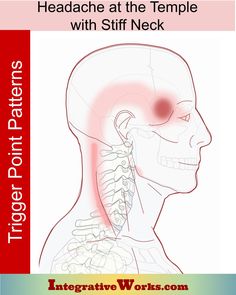 Headache At Your Temple with Stiff Neck - Integrative Works Thoracic Outlet, Cervical Pain, Referred Pain, Pain Relief Patches