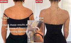 The treatment has gained immense attention online recently, and now, an expert spoke exclusively to DailyMail.com about whether or not the viral procedure is actually effective. Botox In Shoulder, Trapezius Botox Before And After, Shoulder Botox Before And After, Trap Botox Before And After, Botox Trapezius, Traptox Before And After, Plastic Surgeon Aesthetic, Injection Sites