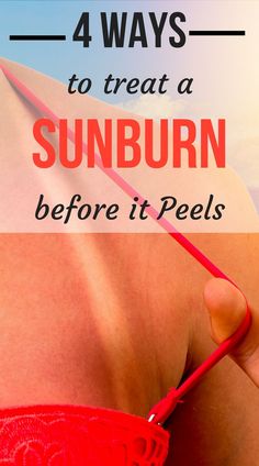 Sunburn On Face, Get Rid Of Sunburn, Heal Sunburn