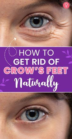 Crow Best Eye Wrinkle Cream Crows Feet Anti Aging, How To Get Rid Of Crows Feet Eye, Crows Feet Remedies, Eye Wrinkles Get Rid Of, Crows Feet Wrinkles How To Get Rid, Facial Remedies, Crows Feet Wrinkles, Home Remedies For Wrinkles, Face Treatments