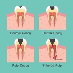 Cure tooth decay through diet - Did you know that it is possible to cure tooth decay? Teeth can actually remineralize!.
#oralhealthcaretips #healthteeth Fix Teeth, Dental Bonding, Family Dentist, Tooth Pain, Teeth Care, Cosmetic Dentistry