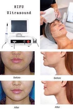 OEM HIFU anti-wrinkle machine. Professional HIFU machine manufacturer-BVLASER. HIFU high intensity focused ultrasound for face lifting. Skin Tightening Machine, Face Lifting, Medical Anatomy, Tattoo Removal, Business Inspiration, Ultrasound, Skin Tightening, Skin Rejuvenation, Anti Wrinkle