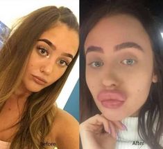 Swollen Lips, Bigger Lips, Big Lips Natural, Avoid People, Lip Filler, Lesson Learned, Bottom Lip, Nigeria News, Cosmetic Treatments