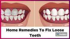 Home Remedies To Strengthen & Tighten Loose Teeth! In this video Learn how to fix loose teeth! Use items found in your own home! Tighten loose teeth! Get rid... Home Remedies For Cavities, Loose Teeth, Teeth Remedies, Tooth Crown, Teeth Caps, Bowl Party Food, Loose Tooth, Stronger Teeth, Receding Gums