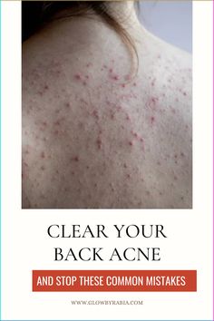 Sick and tired of back acne ? Check this dermatology pharmacist post on how to get rid of back acne fast with the best remedies for back acne. Back acne | back acne treatment | how to get rid of back acne| Back acne remedies | back acne causes| back acne products Backne Remedies Fast, Back Acne Products, Backne Remedies, Remedies For Back Acne, Back Acne Causes, Get Rid Of Back Acne, Rid Of Back Acne, Back Acne Remedies, Cystic Acne Remedies