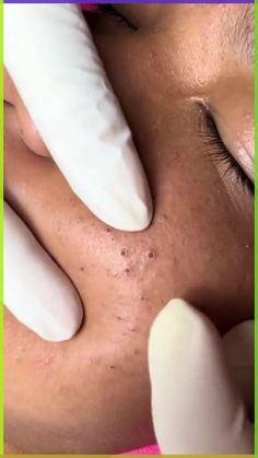 Farewell to Blackheads: The Ultimate Guide #Blackheads #skincare #blackheadremoval #cleanser #facecleanser #beautyhacks Facial Massage Techniques, Bad Skin, Black Head Remover Mask, Facial Tips, Blackhead Mask, Get Rid Of Blackheads, Diy Skincare, Massage Techniques, Facial Massage