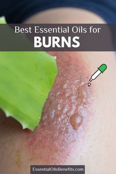 Discover the best essential oils to treat and soothe burns naturally! This guide includes 12 powerful oils and easy-to-follow recipes for quick relief and healing. Perfect for first aid and skincare. #EssentialOils #BurnRelief #NaturalHealing #DIYRemedies #Skincare Essential Oil For Burns, Essential Oils Recipes, Burn Yourself