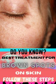 The Truth Behind Brown Spots on Face - Having brown spots on the face is not only disturbing, but it also may turn out to be a sign of more serious skin diseases and problems. You have to take note... Sun Spots On Skin, Sunspots On Face, Spots On Skin, Spots On Forehead, Brown Spots On Hands, Brown Age Spots, Brown Spots On Skin, Lotion For Oily Skin, Spots On Legs