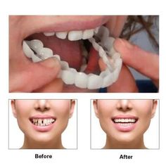 ad eBay - 1 Pack False Teeth Denture Wear Device for Perfectly Fitting Teeth Occlusal - Buy Now, click the link (eBay) Dental Crown Procedure, Snap On Smile, Teeth Covers, Veneers Teeth, Laser Teeth Whitening, False Teeth, Fake Teeth, Teeth Braces, Dental Bridge