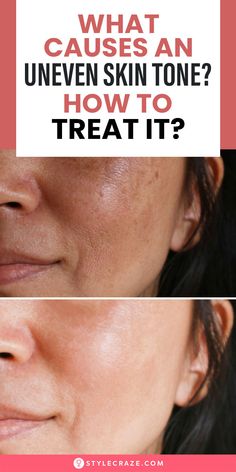 a woman's face with the words what cause an uneven skin tone? how to treat it?