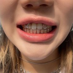 a woman with braces on her teeth