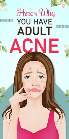 Here’s Why You Have Adult Acne: With age, our skin starts getting dryer; hence, you may need to start looking out for milder and gentler skincare products. You may also have to tailor your regime in accordance with the root cause of your acne. Here are 5 common reasons why your acne is back, plus tips to reclaim your skin #skincare #acne #pimples #skincaretips Comedonal Acne, Back Acne Remedies, Cystic Acne Remedies, Acne Hacks, Teenage Acne, Blind Pimple, Forehead Acne, Pimples Under The Skin, Hacks Makeup