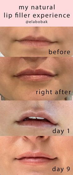 Lip Fillers Healing Process, .5ml Vs 1ml Lip Filler, Lip Filler Recovery, Lip Fillers Before And After 1ml Small Lips, Lip Filler Before And After Small Lips, Restalyne Kysse Lips, Minimal Lip Fillers, Lip Filler Journey