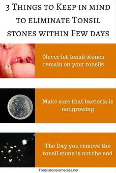 Tonsil Stone Remedies, Tonsil Stones Removal, Tonsil Stone Removal, Tonsil Stone, Herb Diet, Yoga Information, Things To Keep In Mind, Reduce Body Fat