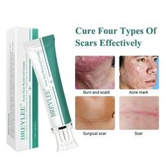 Specifications: It can accelerate the regeneration of cells, making it effective in treating scars left by trauma and burns. Rich in a variety of nutrients needed for skin, can seeps through the skin. Make your skin smooth and delicate. Item Name: Scar Removal Cream Net Content: 30g Features: Moisturizing, Scar Remove, Repairing Size: 14cm x 2.6cm x 3.6cm/5.51" x 1.02" x 1.42" (Approx.) Notes: Due to the light and screen setting difference, the items color may be slightly different from the pict Operasi Caesar, Acne Scar Cream, Acne Scar Removal Cream, Scar Removal Cream, Pimple Scars, Scar Cream, Pimples On Face, Acne Scar, Acne Scar Removal