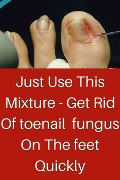 Fungal toenail infections, medically known as onychomycosis, can be uncomfortable and unsightly. They occur when fungi infect one or more toenails, causing discoloration, thickening, and crumbling of the nail. Fortunately, there are several effective remedies and treatments available to combat fungal toenails. In this article, we'll explore 12 proven methods to help you get rid of fungal toenails and restore healthy nails. #nail #toenail #fungus Fingernail Fungus, Nails Today