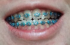 Aqua Braces Blue, Blue Braces, Braces Retainer, After Braces