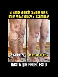 remedios caseros simples y fáciles de usar para las várices Varicose Vein Removal, Varicose Vein Remedy, Home Health Remedies, Skin Care Remedies, Good Health Tips, Natural Health Remedies, روتين العناية بالبشرة, Beauty Skin Care Routine, Body Treatments