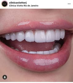 Porcelain Veneers Perfect Teeth Aesthetic, Aesthetic Teeth, Bentuk Alis