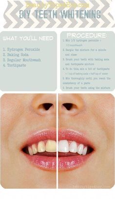 Teeth Whitening Procedure, Teeth Whitening Homemade, Whitening Teeth, Teeth Whitening Diy, Diy Teething, Body Hacks, Super White, Tooth Decay, Mouthwash