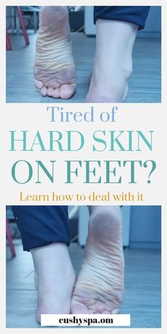 Step by step guide on how to get rid of dead skin on feet. Also includes foot soak recipes and tips on removing hard skin. Foot care tips! #hardskinonfeet #howtogetridofhardskin #footcare  via @cushyspa Foot Care Tips, Foot Soak Recipe, Clear Skin Tips, Foot Soak, Foot Care, Hand Care, Skin Tips, Step By Step Guide, Skin Care Regimen