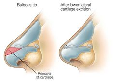 Bulbous Tip Rhinoplasty Illustration from SpaMedica Toronto Tip Rhinoplasty, Nose Profile, Nose Plastic Surgery, Bulbous Nose, Nose Types, Nose Jobs, Nose Reshaping