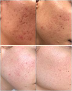 Acne Scarring Remedies, Mesotherapy Before And After, Heal Acne Scarring, Acne Scar Makeup, Dermapen Before And After, Acne Before And After, Acne Scar Products, Skin Problems Face, Microneedling Before And After