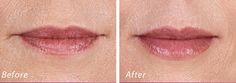 https://flic.kr/p/H2FzaK | Volbella Lip Filler | Volbella Lip Filler Dr. John L. Burns, Jr., MD Board Certified Plastic Surgeon President, Dallas Plastic Surgery Institute Hyaluronic Acid Fillers, Facial Fillers, Lip Filler, Lip Fillers, How To Line Lips, Plastic Surgeon, Lip Plumper, Plastic Surgery, Surgery