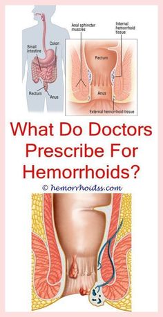 Fastest Removal of Hemorrhoids With These Natural Remedies ! Cortizone 10, Hemorrhoid Removal, Thrombosed Hemorrhoid, Preparation H, Hemorrhoid Relief, Witch Hazel, Natural Treatments, Home Remedies