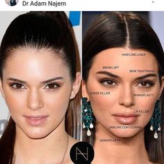 Kylie Jenner Plastic Surgery, Face Plastic Surgery, Celebrity Surgery, Stile Kendall Jenner, Rhinoplasty Nose Jobs, Face Fillers, Botox Lips, Pretty Nose, Facial Surgery