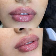 Russian Keyhole Lips, Lip Goals, Juvederm Lips, Chin Filler, Honey Brown Hair