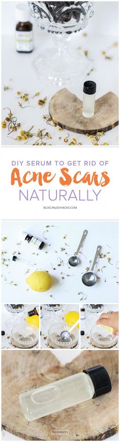 This simple lemony DIY serum with essential oil is great for spot treating acne scars and healing aging spots. Plus, it smells delicious! Homemade Serum, Acne Scar Remedies, Scar Remedies, Diy Serum, Acne Makeup, Natural Acne, Treat Acne, Acne Scar Removal, Acne Serum