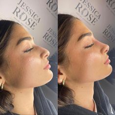 Perfect Nose Profile, Button Nose Filler, Cute Noses Woman, Nose Ideas For Nose Job, Small Nose Rhinoplasty, Nose Job Ideas, Small Nose Job, Noses For Nose Jobs, Nose Job Nose