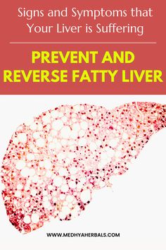 reverse fatty liver, liver healthy foods, healthy liver, natural remedies for liver health Liver Issues, Healthy Living Motivation, Liver Function, Health Signs, Disease Symptoms